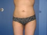 Liposuction