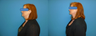 Neck Liposuction