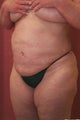 liposuction of abdomen and flanks