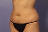 Liposuction