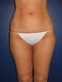 Liposuction