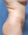 Liposuction