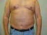 59 year old male liposuction
