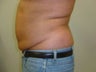 59 year old male liposuction