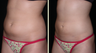 Liposuction