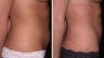 Liposuction