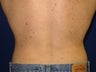 Liposuction