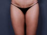 Liposuction