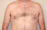 Before and After Gynecomastia Treatment With Liposuction