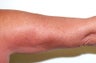 Upper Arm Liposuction