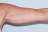 Upper Arm Liposuction