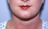 Neck Liposuction