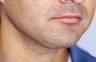 Neck Liposuction