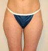 Power Assisted Liposuction