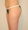 Power Assisted Liposuction