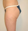 Power-Assisted Liposuction
