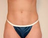 Liposuction