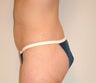 Power Assisted Liposuction
