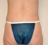Power Assisted Liposuction