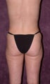 Mommy makeover - Lipo, tummy tuck