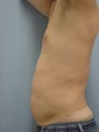 Liposuction