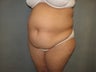 Tummy Tuck