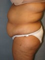 Tummy Tuck and Liposuction