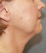 Liposuction