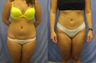 Liposuction