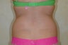 Liposuction