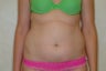 Liposuction