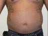 Liposuction