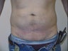 Liposuction