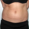 Liposuction