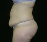 abdominoplasty with lipo