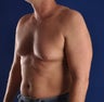 VASER assisted hi definition liposuction