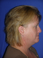 Liposuction of neck