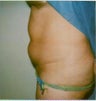 Liposuction