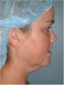 Neck Liposuction (submental liposuction)