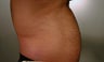 Liposuction