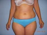 Tummy tuck plus liposuction