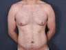 Liposuction