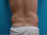 Liposuction