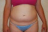 Liposuction of the abdomen