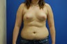 Liposuction of Abdomen and Flanks
