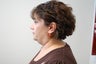 Liposuction Neck