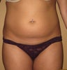 Liposuction