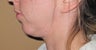 Chin Liposuction