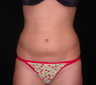 Liposuction