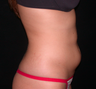 Liposuction